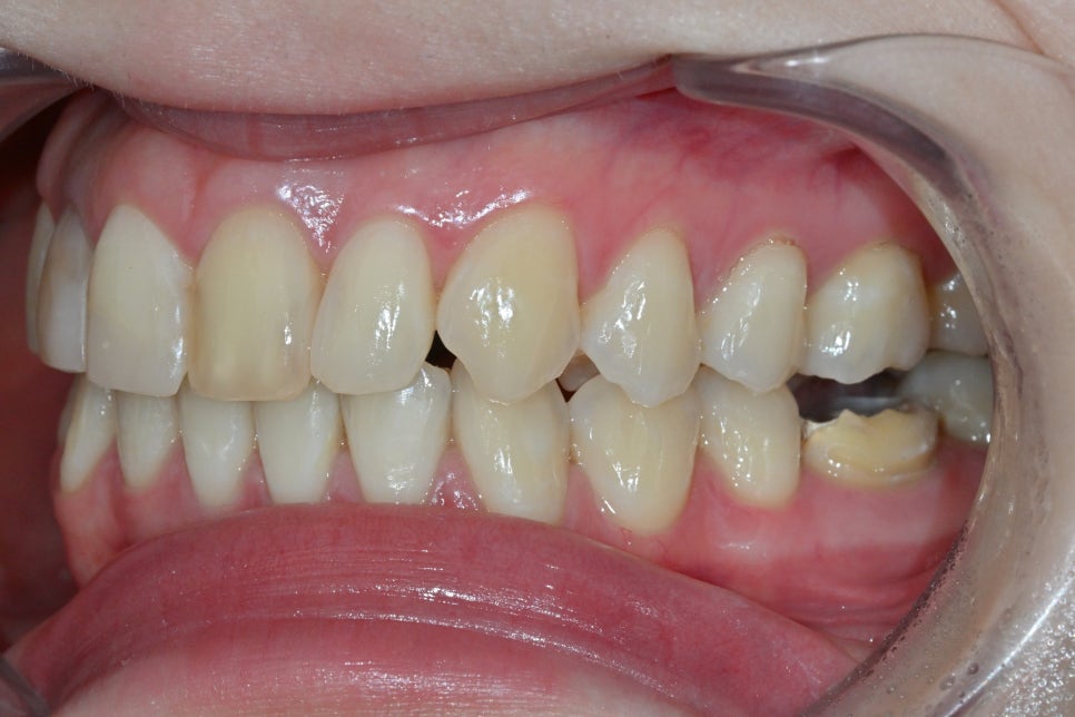 Discolored Front Teeth: Are Crowns the Only Answer? image 5