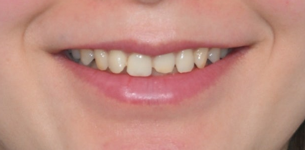 Tooth Wear: Resin? Veneers Are Also an Option image 6