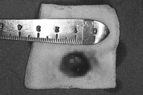 Samjeon Station Dental Clinic: A man in his 30s who visited after breaking his front tooth, and a case in which a cyst was found and implant surgery was also performed image 3