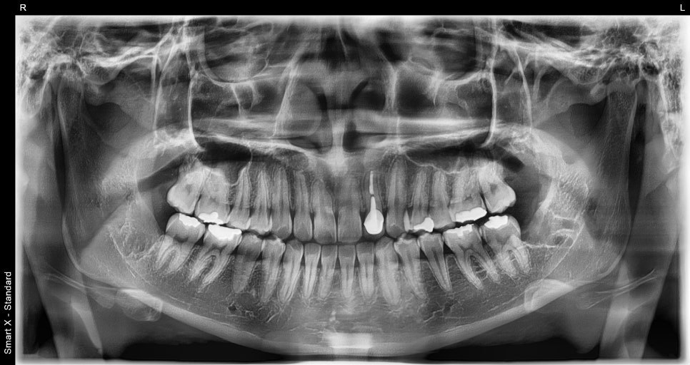 Do I Need to Have My Wisdom Tooth Removed Even If It Doesn’t Hurt?🦷Extraction Criteria Explained by an Oral Surgery Specialist image 2