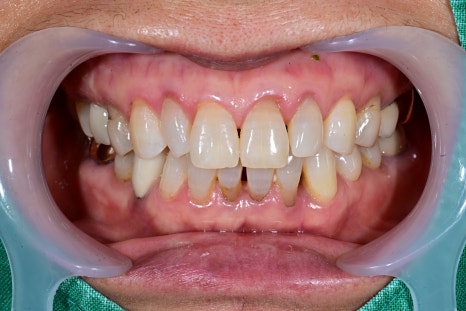 Is an Implant Price Really Worth Trusting? image 6