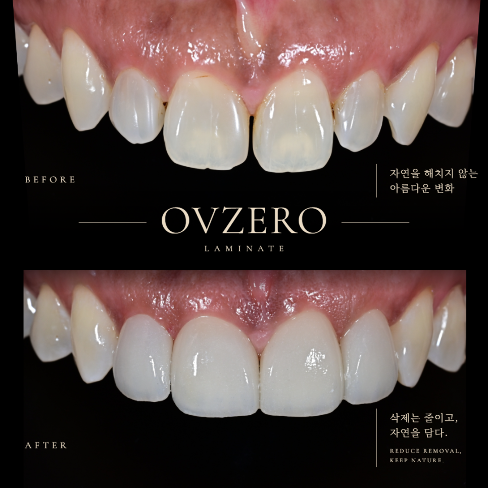 외국 거주 외국인 무삭제 라미네이트 (오브제로라미네이트) 관련 이미지 1