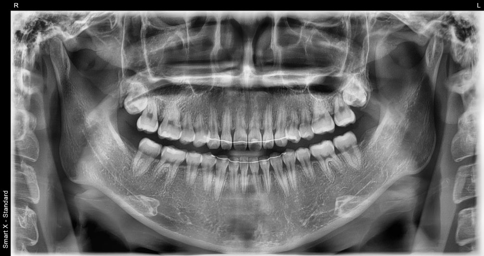 Samjeon Station Dental Clinic: A Case of Improving Discolored Teeth with No-Prep Ove Zero Laminates image 3