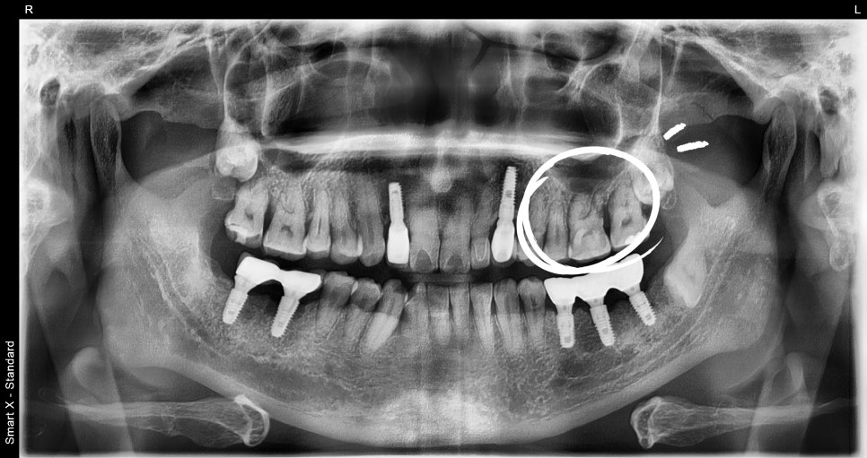 어금니 임플란트가격, 임플란트치과에서 진행한 실제 치료 과정 관련 이미지 3