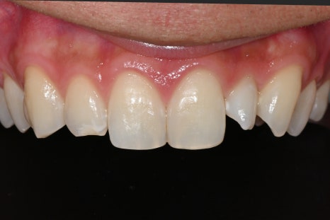 Do Men Get Laminates Too? The Choice of a Man in His 20s Who Became Naturally More Attractive image 5