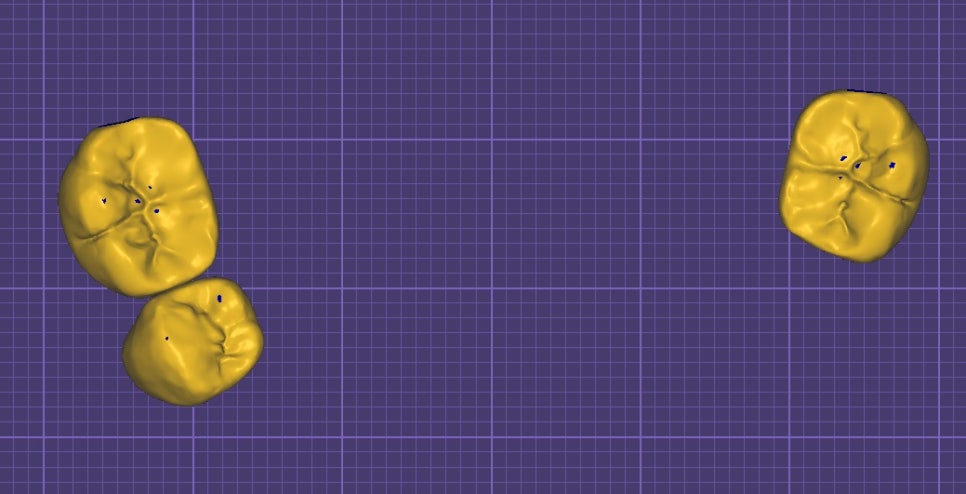 Implant Treatment Available for Foreign Residents Abroad! A Case Completed Perfectly Within 3 Months image 5