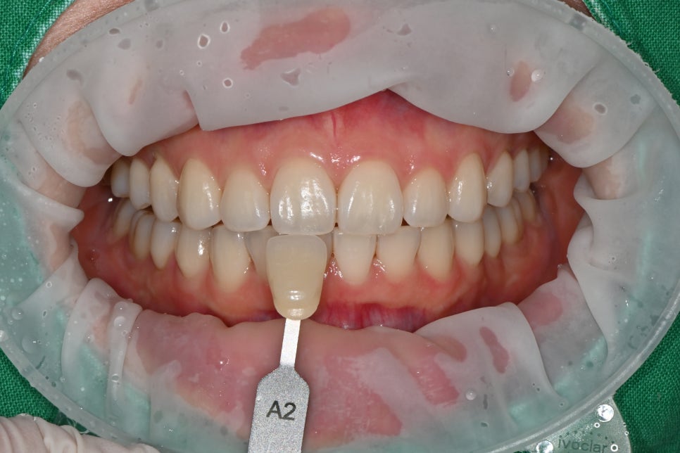 Songpa Teeth Whitening Price, Treatment Review image 4