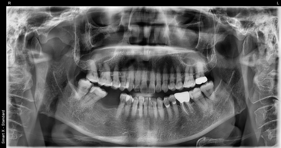 Songpa-gu Implant: Surgical Case of a Foreign Woman in Her 50s (feat. Foreigners’ Dental Clinic) image 1