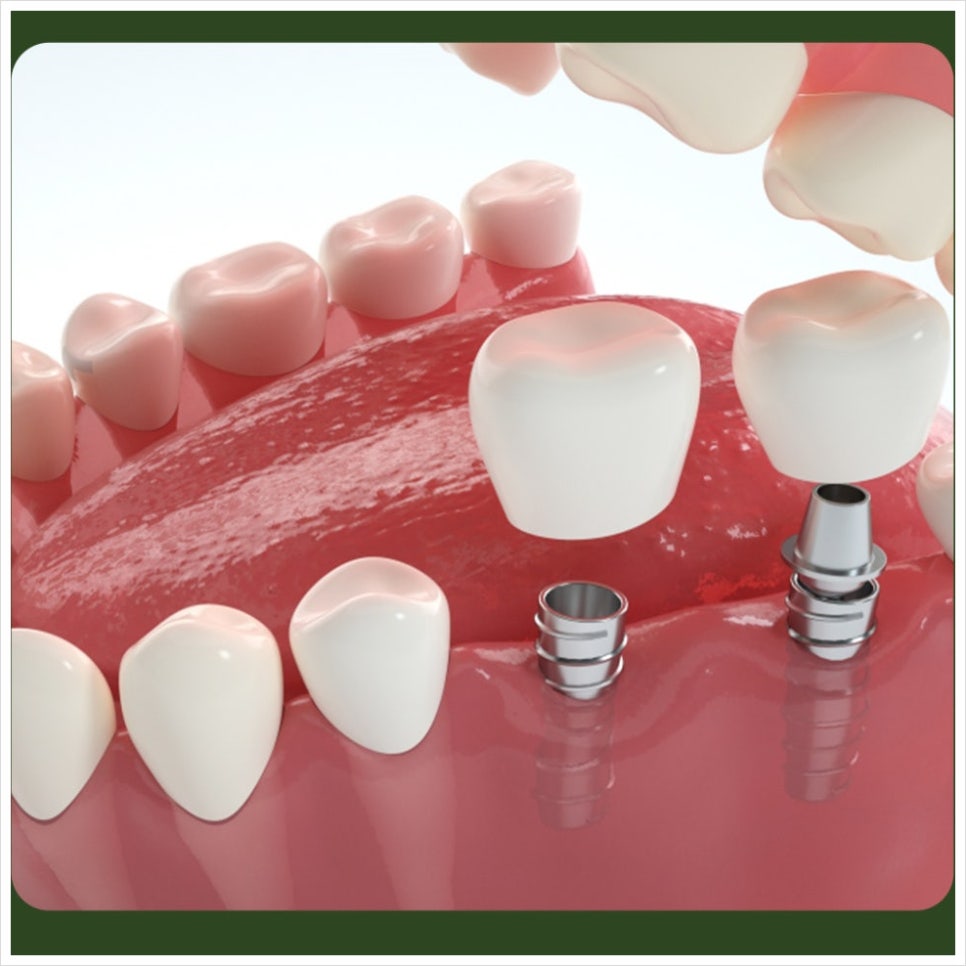 What Should I Do If My Implant Feels Loose? image 2