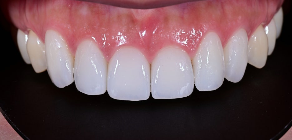 Laminates Price, Zero-Reduction Laminates with Ovzero image 11