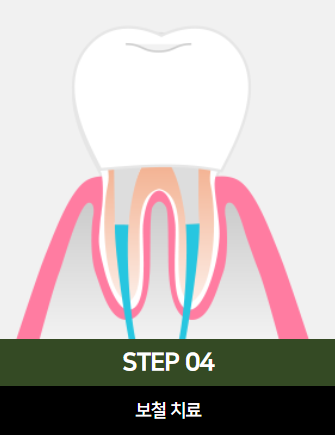The Power to Protect Natural Teeth: Seoul Orbe Dental Hospital’s Philosophy of Conservative Treatment image 14
