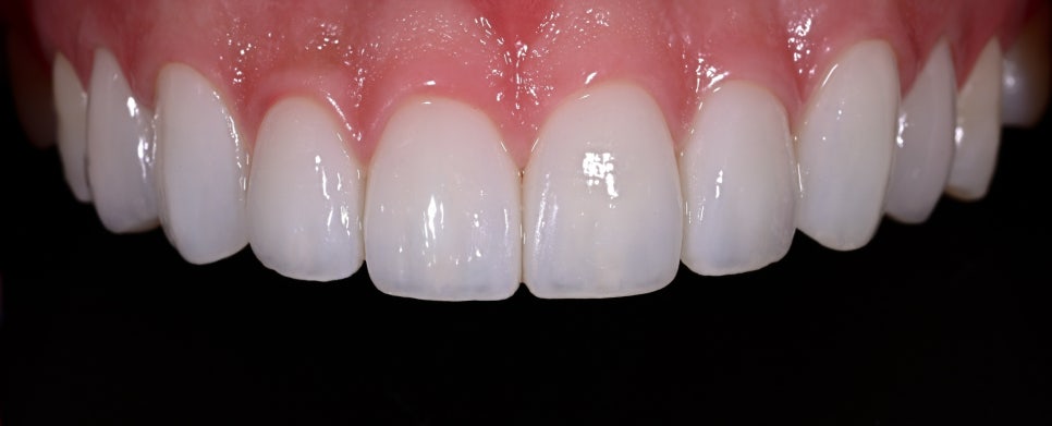 The Real Reason for the Price Difference in Laminates: See for Yourself with OVZERO Minimally Prepared Veneers image 10