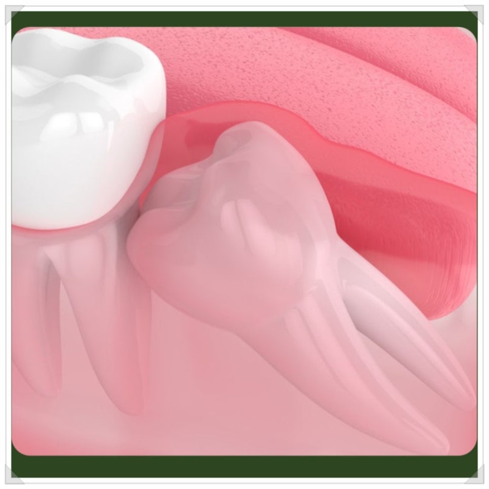 Wisdom Tooth Inflammation: Don’t Leave It Alone—Please Have It Removed! image 3