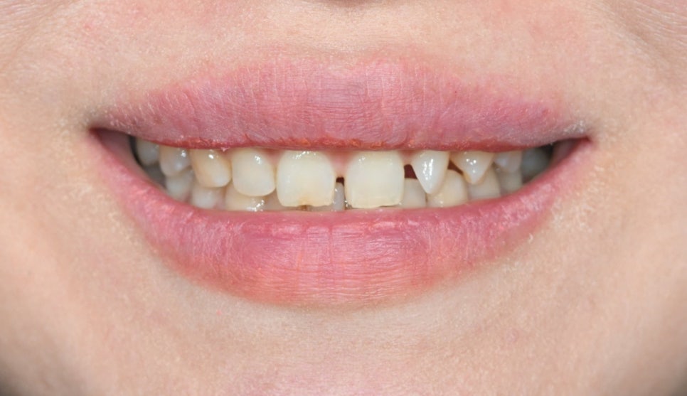 Can Gaps Between the Front Teeth Be Treated with Composite Resin? A Case Treated with Veneers image 3