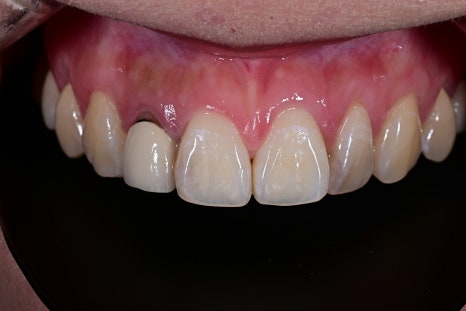 How We Naturally Improved an Upper Front Tooth Crown Retreatment, Including Color Differences and the Gum Line image 9