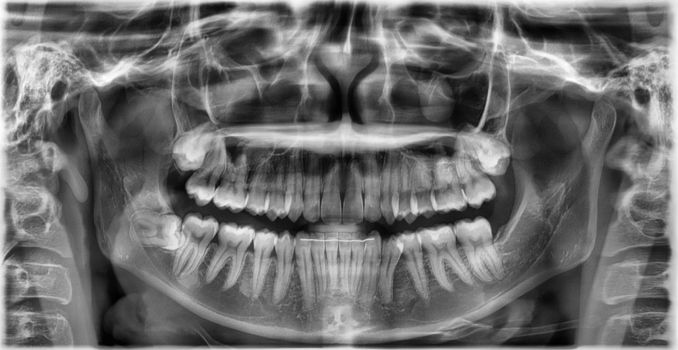 Jamsil Wisdom Tooth Extraction: If It Doesn’t Hurt, Is It Okay to Keep Putting It Off? image 3