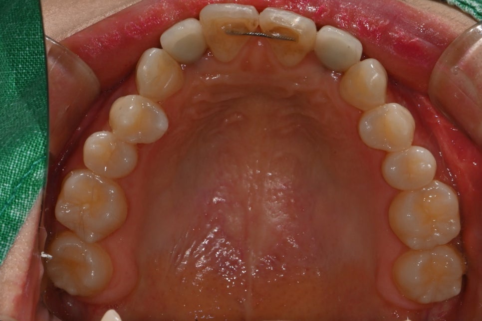A Case of Simultaneous Laminate and Implant Prosthetic Treatment image 4