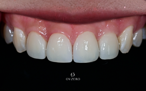 Objeo Laminate Cost, Treatment Review from a Woman in Her 20s image 5