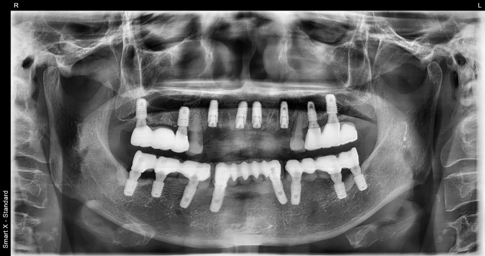 앞니 임플란트, 전치부 심미까지 살린 치료 과정 정리 관련 이미지 13
