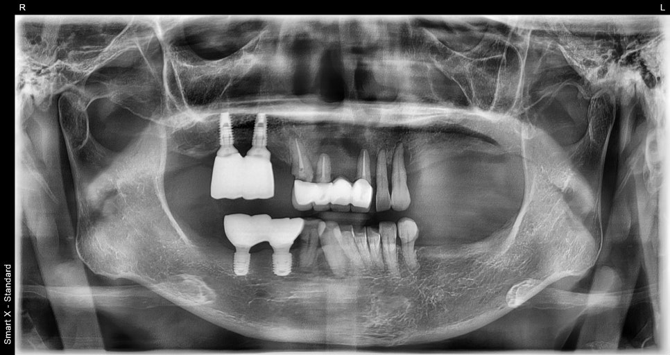 Full-Mouth Implant Price: Treatment Review of a Patient in Their 60s Who Restored Damaged Teeth image 6