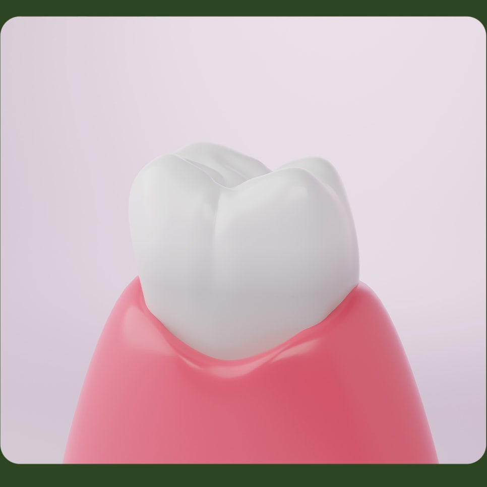 What Causes Tooth Cracks? Why Do They Form? image 2