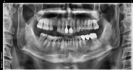 Are you afraid of the dentist? With sedation treatment, you can get root canal treatment and implant surgery without worry! image 1