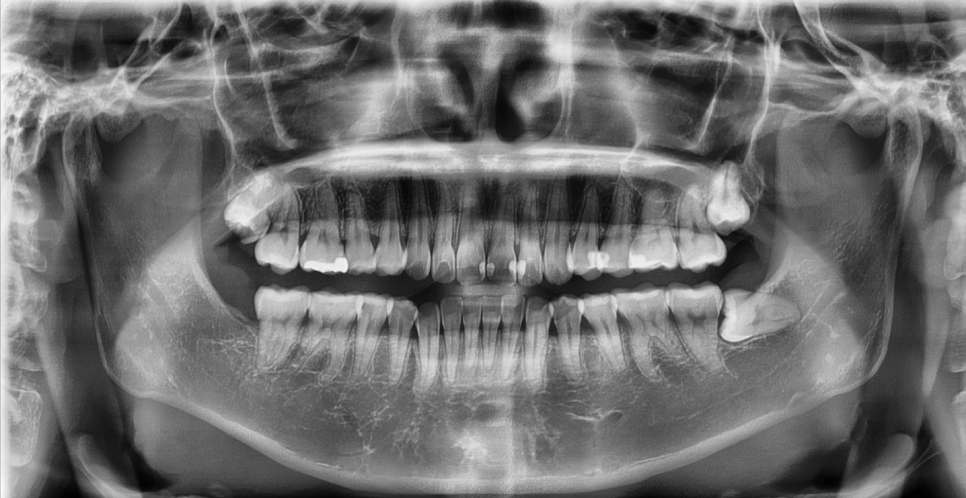 Natural-looking Front Teeth Completed with Laminate Veneers in Jamsil image 6