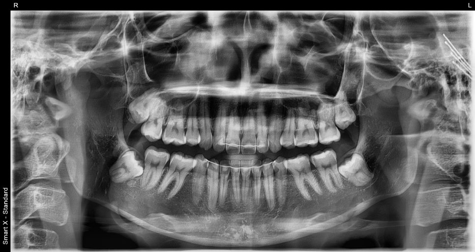 Samjeon Station Dental Clinic: "Without Orthodontics, Object Zero for the Smile Line of a Woman in Her 20s" image 1