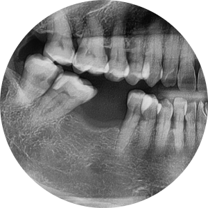 Songpa-gu Implant: Surgical Case of a Foreign Woman in Her 50s (feat. Foreigners’ Dental Clinic) image 2
