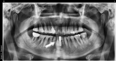 Implant Surgery and Precautions for Insurance Patients in Their 60s image 4