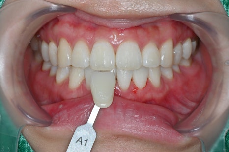 Wedding D-14, It’s Time for Whitening Now!🦷 image 2