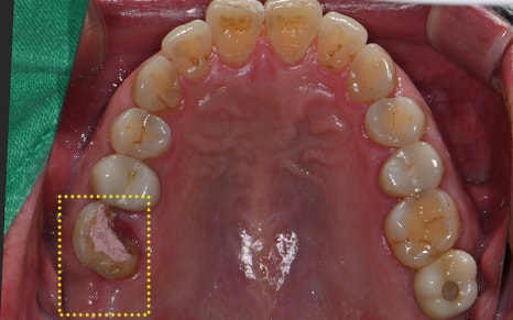 Songpa-gu Dental Clinic: Solving a Case Where Prosthetics Were Impossible with Implant Reoperation! image 2