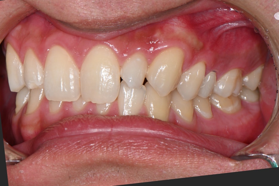 Object Zero Front Tooth Laminate, Minimizing Tooth Reduction image 11