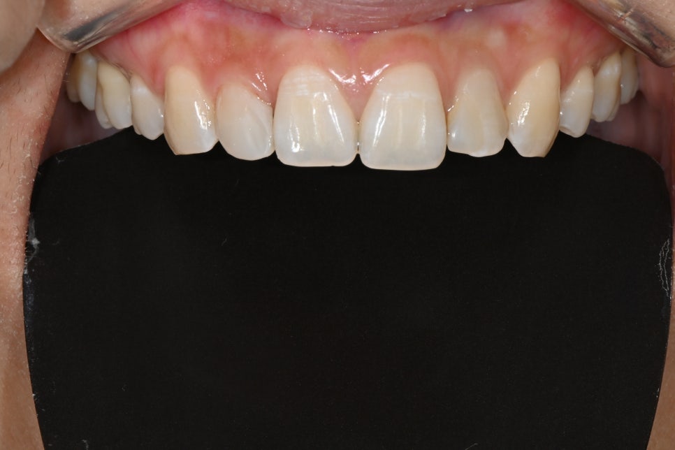 What If a Resin Filling Fell Out in the Past? Be Sure to Read This Before Retreatment! image 3