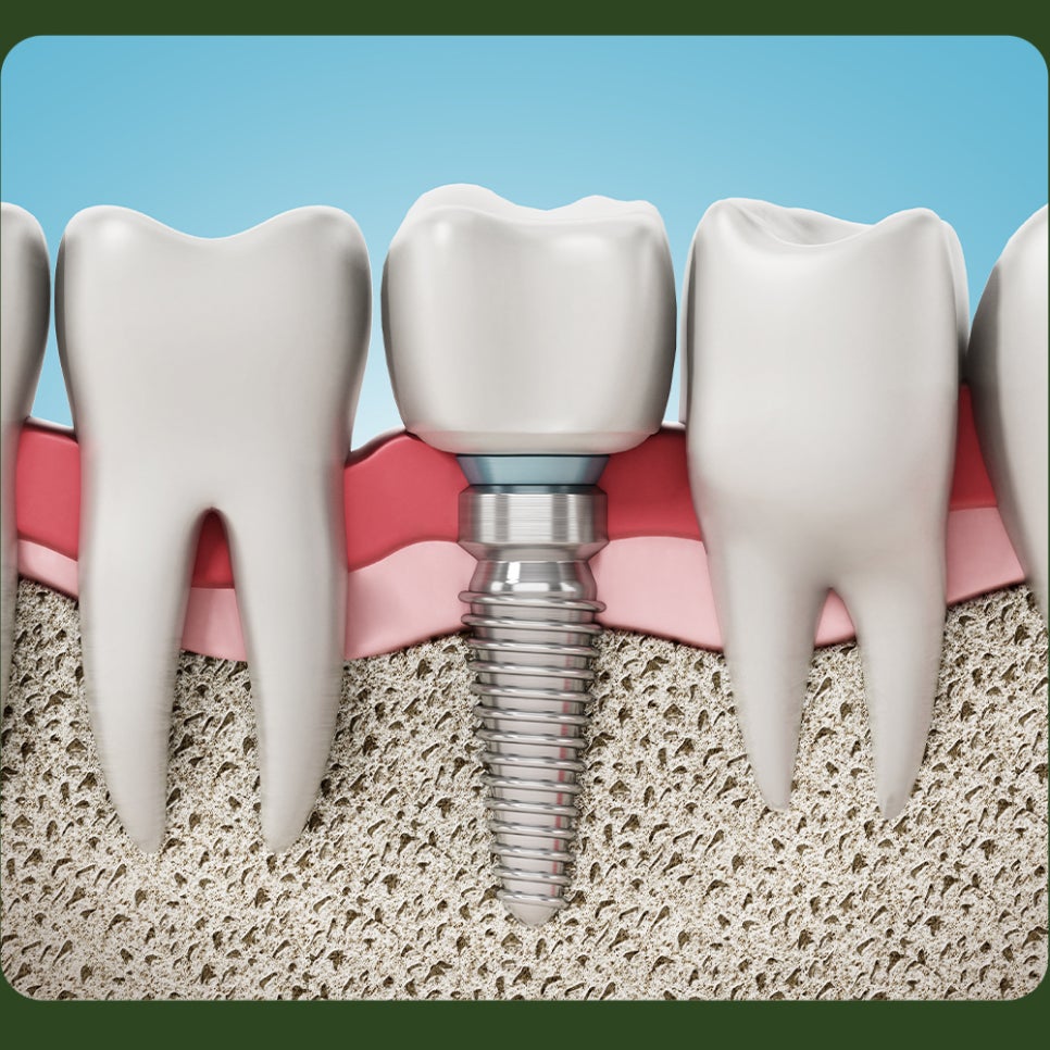 Please Be Careful with Smoking After Dental Implants! image 2