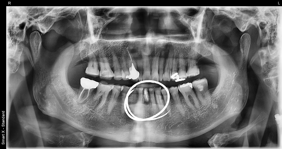Implant Surgery and Precautions for Insurance Patients in Their 60s image 1