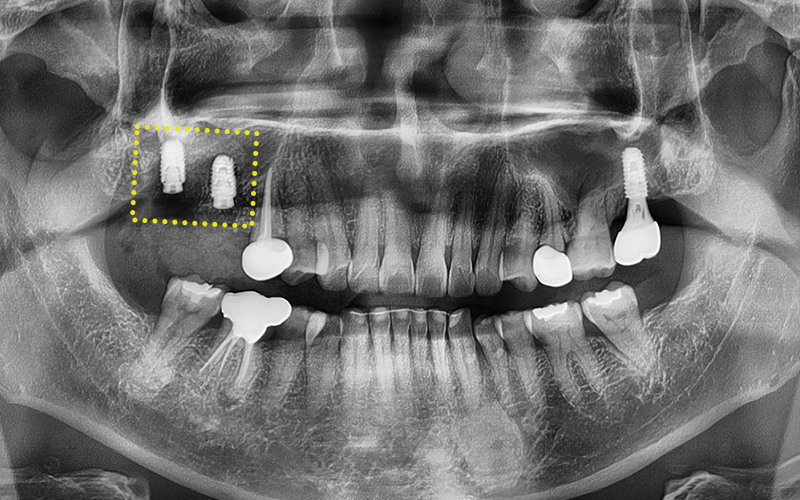 Songpa-gu Dental Clinic: Solving a Case Where Prosthetics Were Impossible with Implant Reoperation! image 6