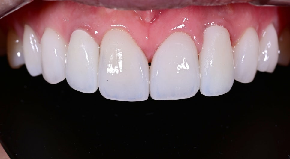 A Case of Simultaneous Laminate and Implant Prosthetic Treatment image 7