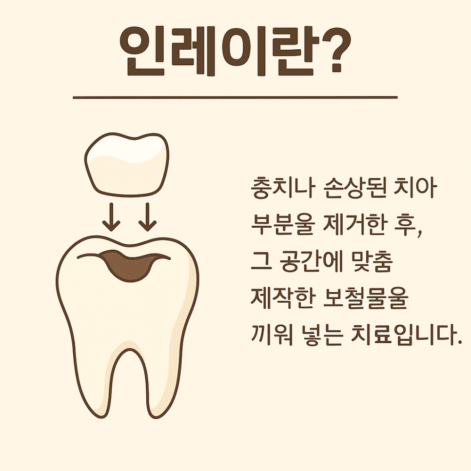 Inlay Treatment Review in Songpa-gu, Seoul – Completed in 1 Week with Precision Scanning and Lab Work image 1
