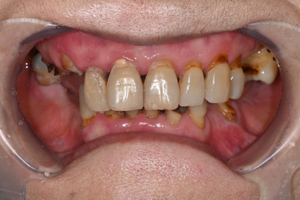 Full-Mouth Implant Price: Treatment for a Patient Over 65 Performed Under Sedation image 3