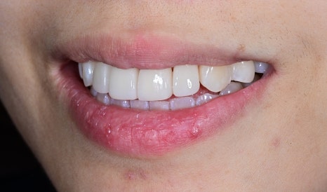 Laminate Veneers for Protruding Teeth: If They’re Too Thick, They Look Even More Prominent image 10
