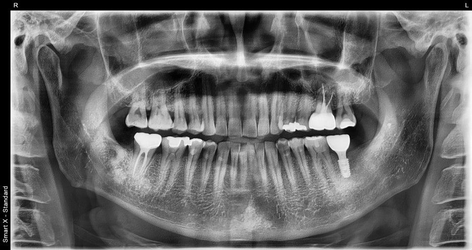 Jamsil Dental Hospital Implant Price and Treatment Case image 12