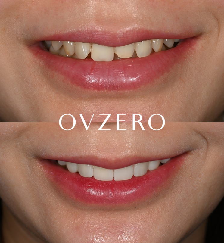Tooth Wear: Resin? Veneers Are Also an Option image 12