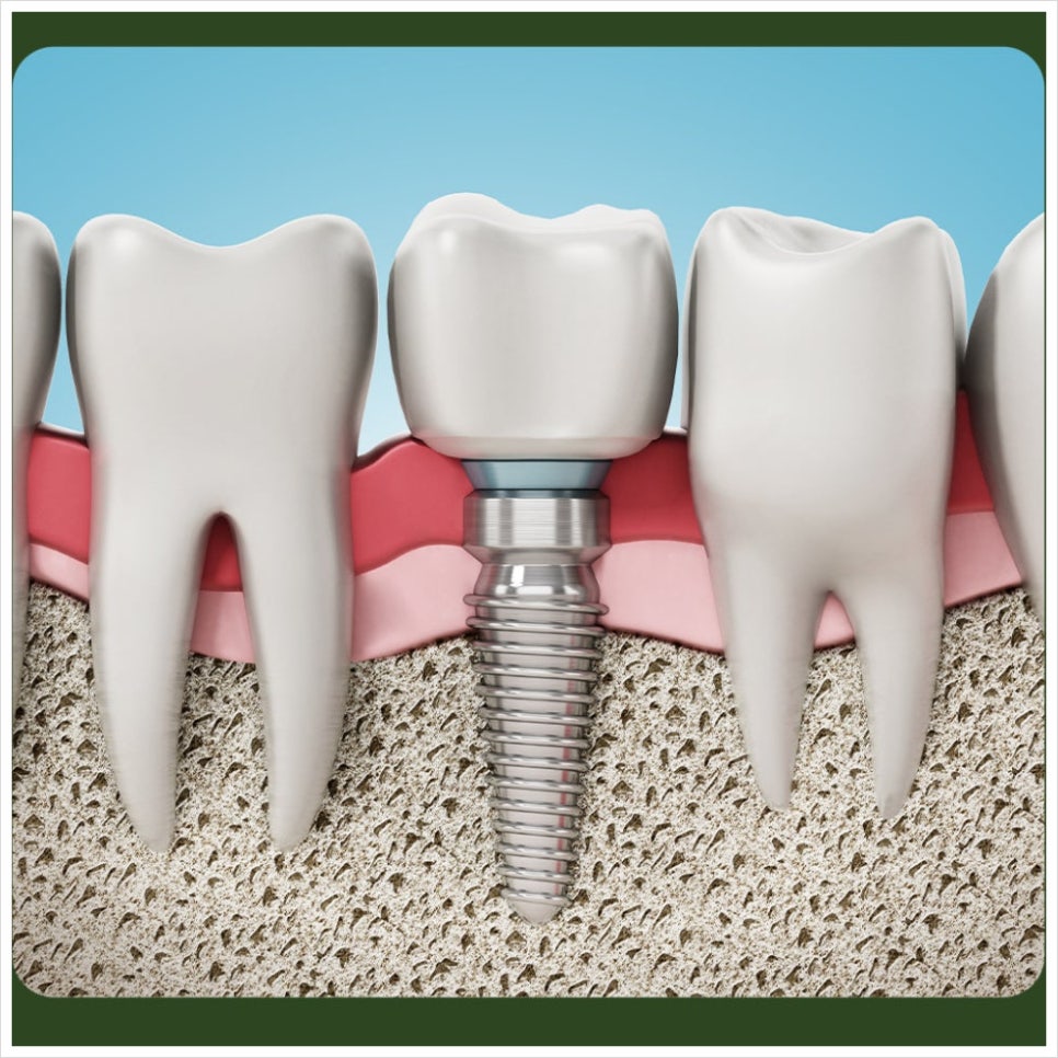 When Is Same-Day Implant Treatment Possible? image 4