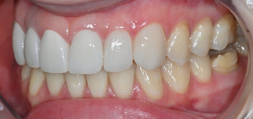 Discolored Front Teeth: Are Crowns the Only Answer? image 9