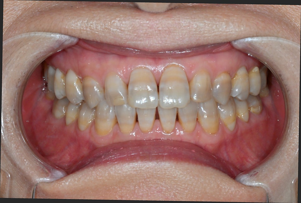 Objet Laminate Treatment for Seniors: Naturally Beautiful, Without Tooth Reduction image 3