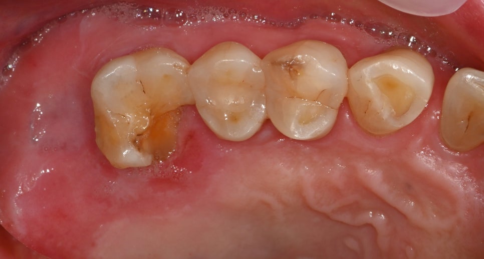 Things You Must Check Before Implant Treatment image 10