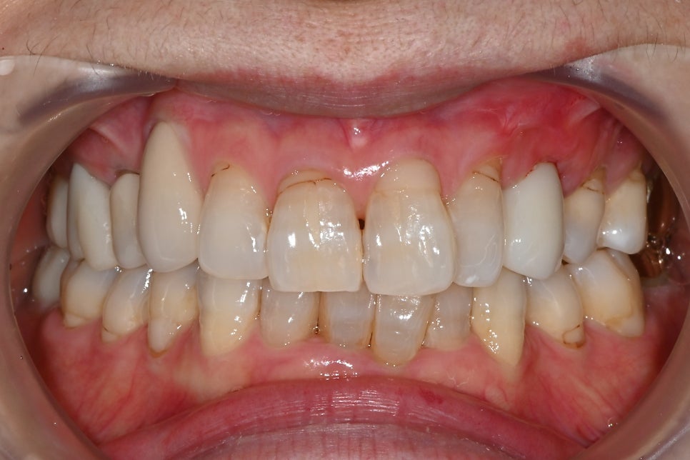Songpa-gu Front Tooth Implant: Is It Possible Even in an Inflamed Area? image 8
