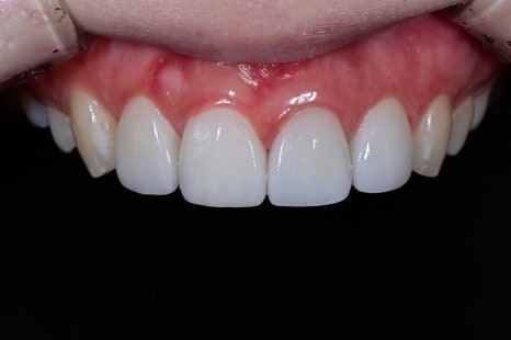 Rabbit Teeth Veneers: Treatment to Achieve Natural Front-Tooth Proportions image 4