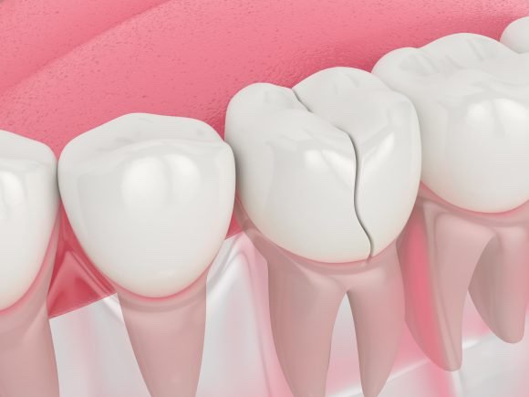 From Cavities to Chipped Front Teeth, Fast and Natural! image 4
